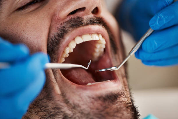 Best Emergency Tooth Extraction in Statesboro, GA